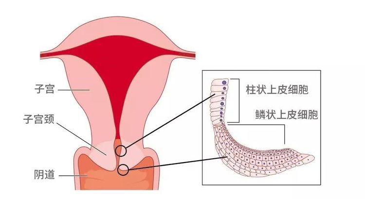 宫颈“糜烂”不是病，是正常生理现象