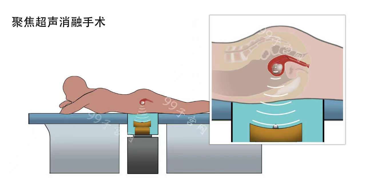 别人治疗子宫肌瘤切子宫，我却还怀孕了