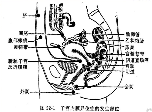 除开子宫，内异症还能长到哪些部位？