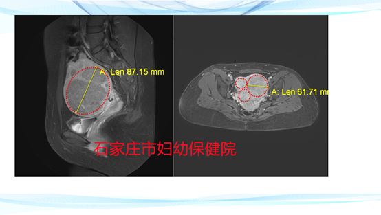 心怀希望而来 梦圆满意而归：一例多发性子宫肌瘤典型病例介绍