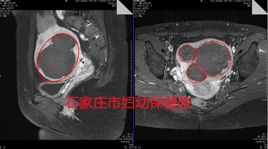 心怀希望而来 梦圆满意而归：一例多发性子宫肌瘤典型病例介绍