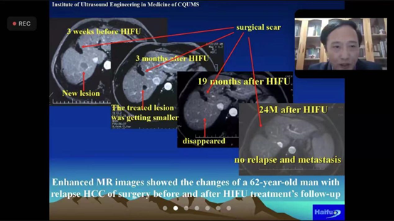 国际微无创医学会——高强度聚焦超声（HIFU）治疗肝癌及胰腺癌首期线上研讨会成功举行