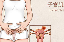 “子宫肌瘤”出现这种情况要注意！可能是恶性