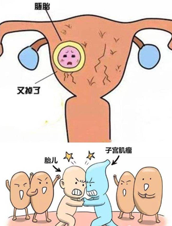 孕前查出子宫肌瘤，带瘤怀孕，你敢吗？