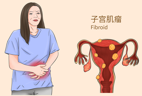 聚焦超声消融可以治疗阔韧带子宫肌瘤吗？