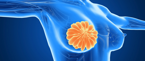 聚焦超声消融如何治疗乳腺癌