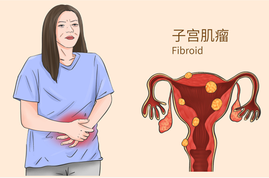 子宫平滑肌瘤手绘图图片