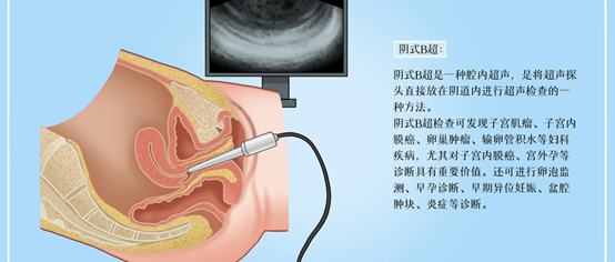 阴式B超能检查什么？