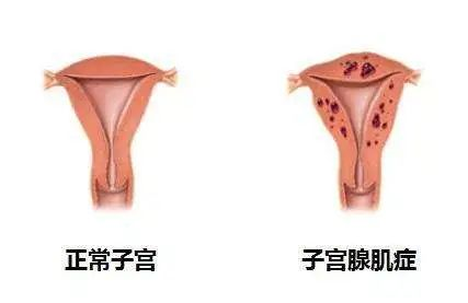 子宫腺肌病会癌变吗？