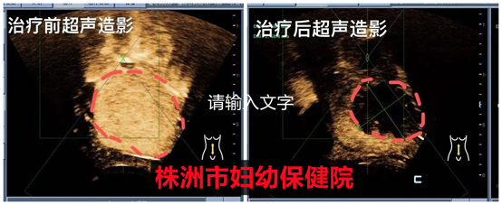 得了子宫腺肌病不孕怎么办？海扶助您好孕！