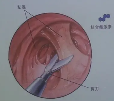 宫腔粘连的症状有哪些，如何治疗？