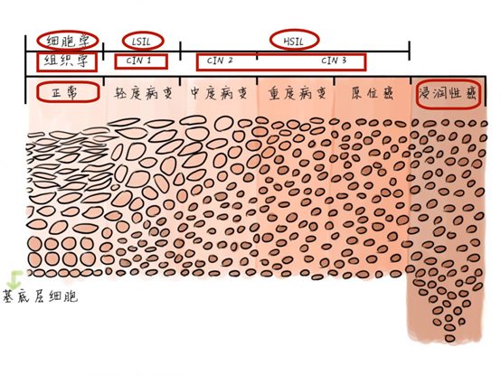 检查单上有CIN或LSIL，治还是不治，如何治？