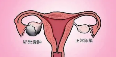 卵巢长囊肿了，该怎么办？