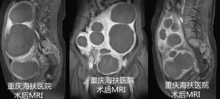 多发性子宫肌瘤，可优先选择这种方式治疗