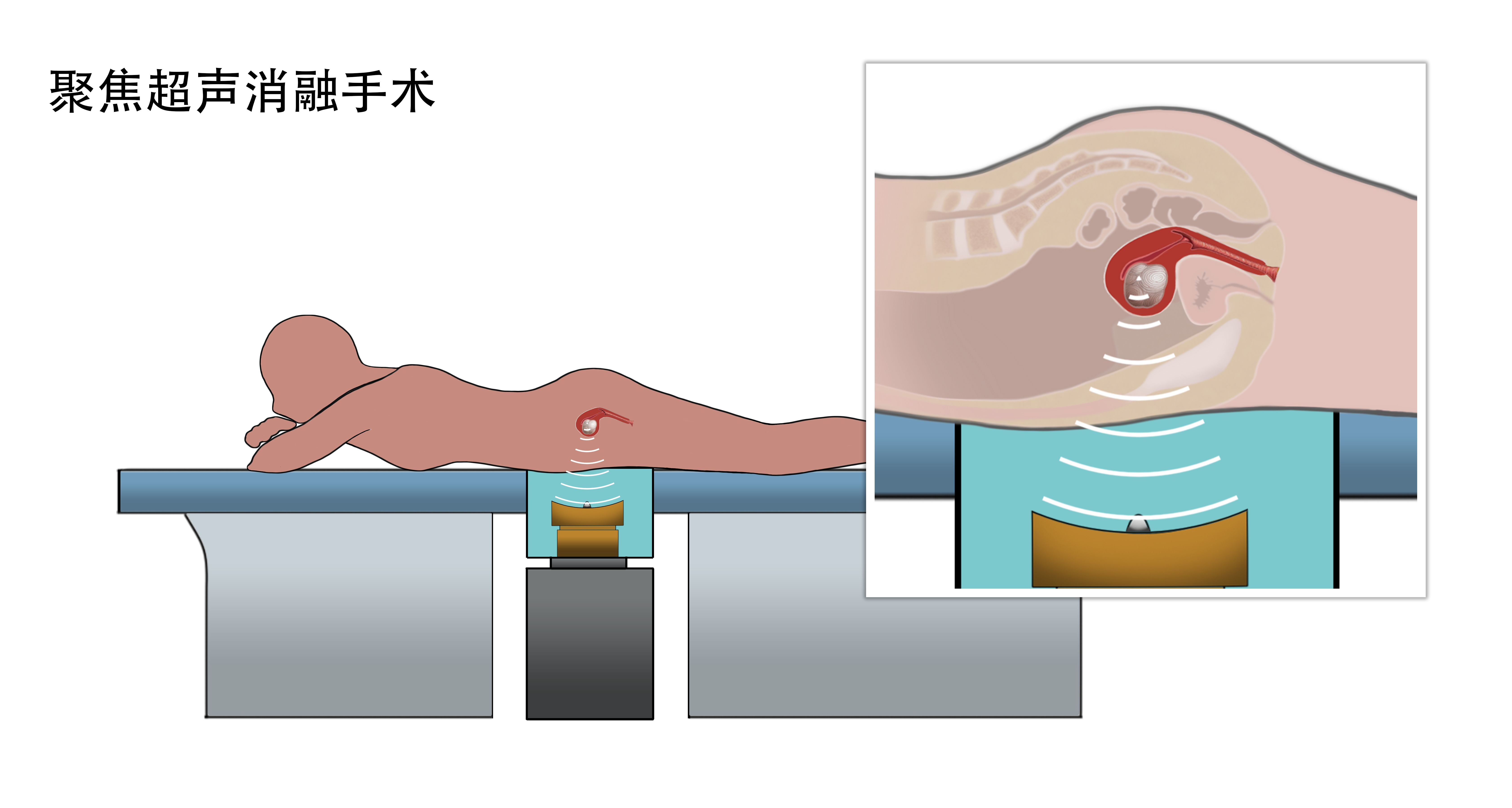 多发性子宫肌瘤，可优先选择这种方式治疗