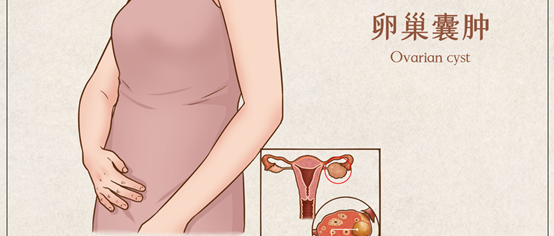 卵巢囊肿很大几率是这几种原因，请对号入座