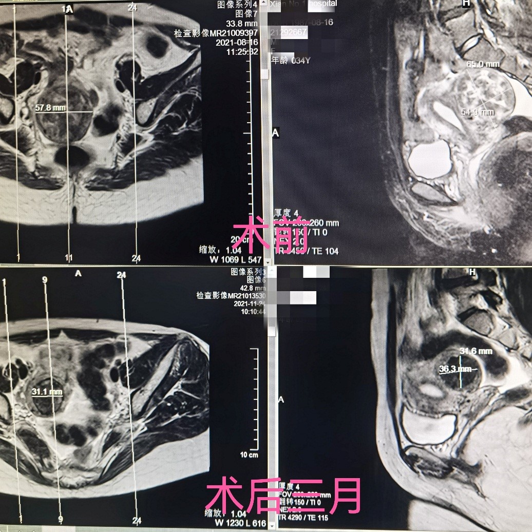 子宫肌瘤做聚焦超声消融手术后多久可以完全吸收？