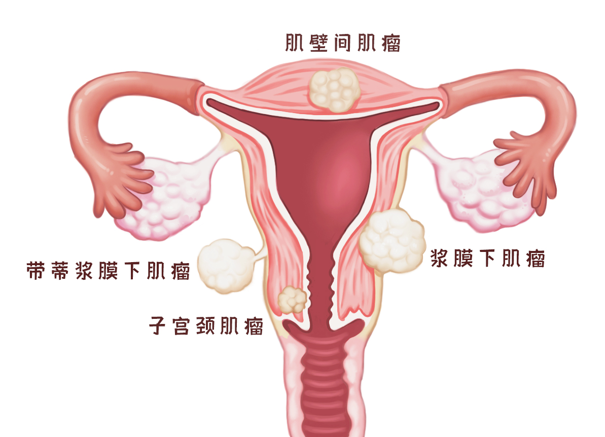 聚焦超声消融手术对子宫后壁的肌瘤效果会不好吗？