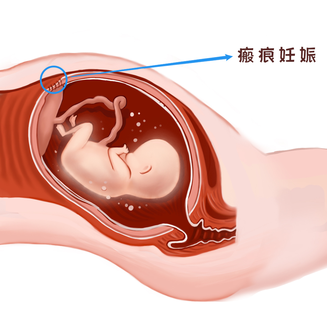 剖宫产瘢痕妊娠就是一个“炸弹”，看专家如何“拆弹”