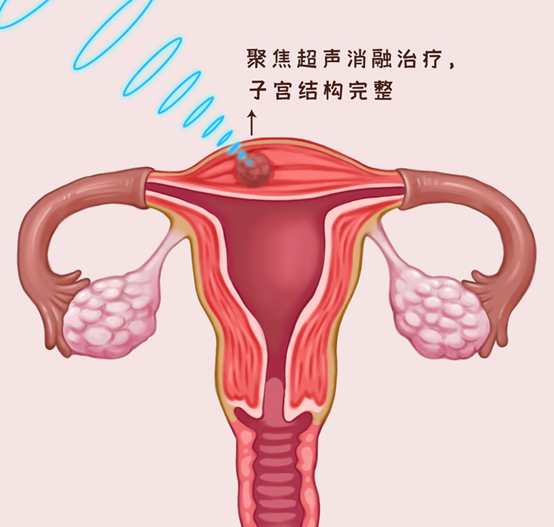 子宫肌瘤做聚焦超声消融手术后，需要完全吸收后才能怀孕吗？