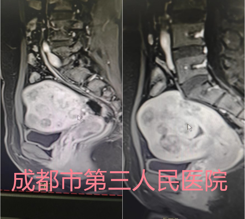 多发子宫肌瘤合并腺肌瘤，48岁的她子宫能不能保住