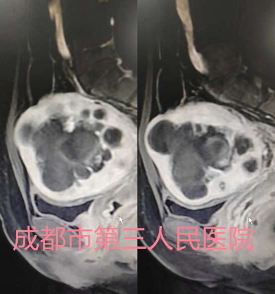 多发子宫肌瘤合并腺肌瘤，48岁的她子宫能不能保住