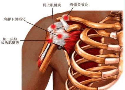 肩痛≠肩周炎，这个误区你知道吗