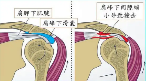 肩痛≠肩周炎，这个误区你知道吗