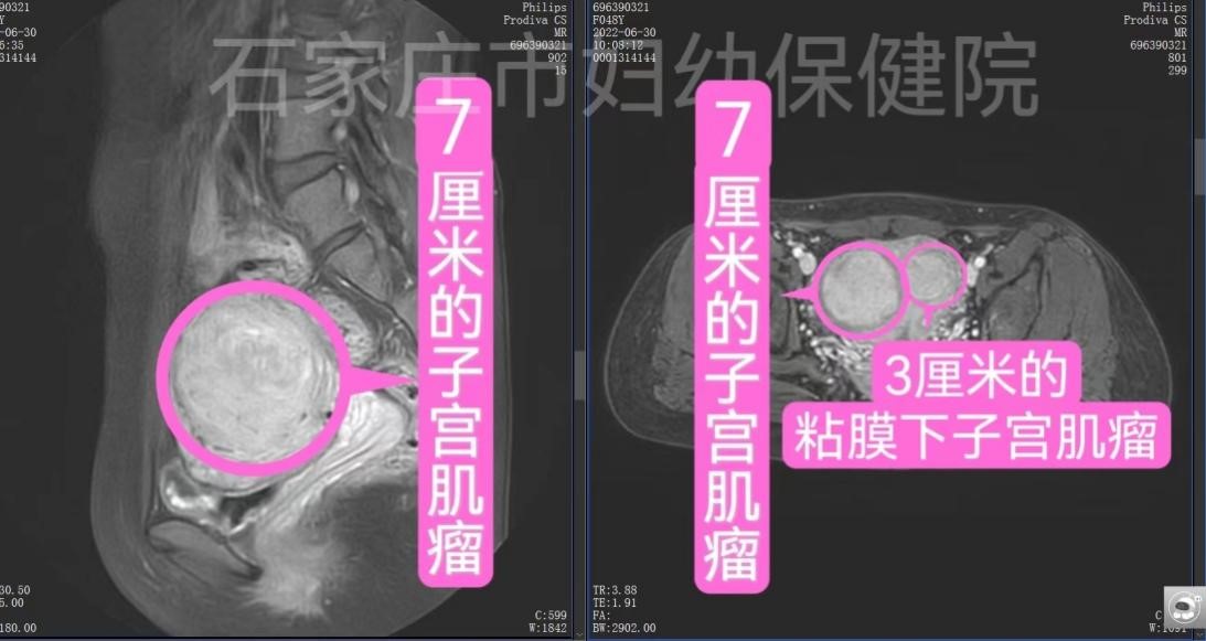 迎难而上，挑战又一例高难度手术！