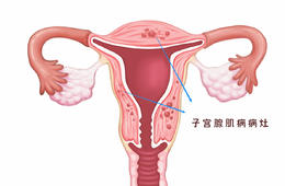 有生育需求的子宫腺肌病患者该怎么手术