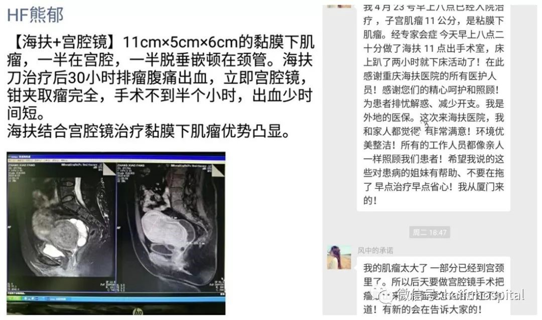 海扶+宫腔镜，组合拳出击11cm粘膜下子宫肌瘤