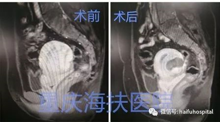 宫腺肌病痛经3年，但这一次，我告别了止痛针！