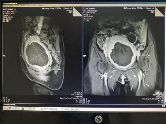 一波三折的子宫肌瘤遭遇：医生切开我的肚子，却不敢取瘤就匆匆缝合了……