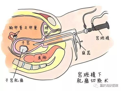 HIFU+宫腔镜，完胜13公分巨大粘膜下子宫肌瘤