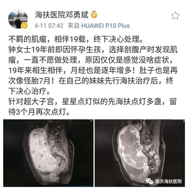 看海扶刀如何收拾这不羁的肌瘤