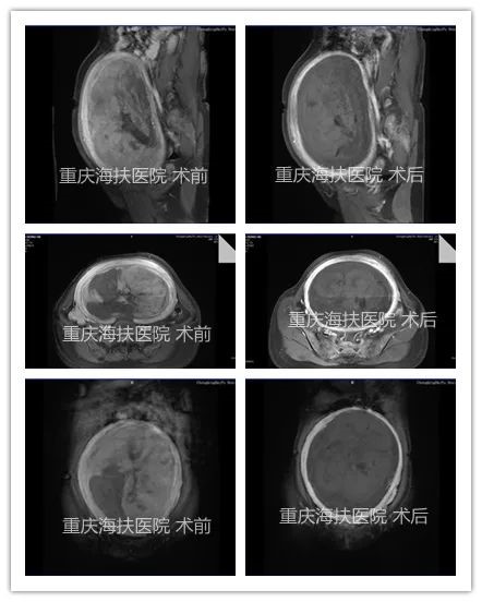 聚焦超声消融治疗23cm巨大子宫肌瘤