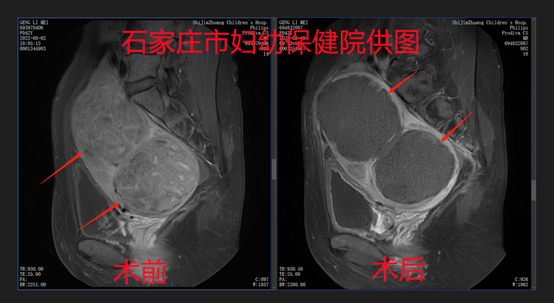 为了尽快恢复，她选择聚焦超声消融治疗