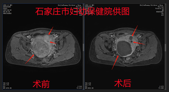 为了尽快恢复，她选择聚焦超声消融治疗