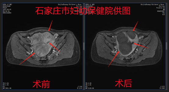 为了尽快恢复，她选择聚焦超声消融治疗