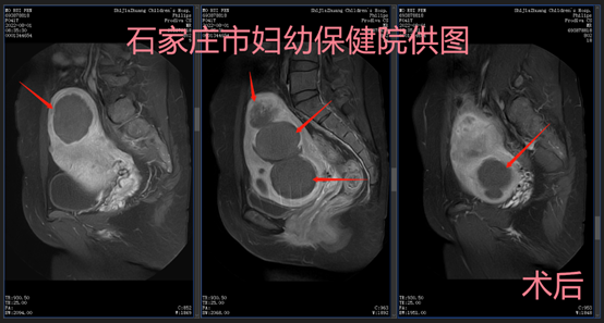 不开刀、不受罪，轻松解决子宫肌瘤