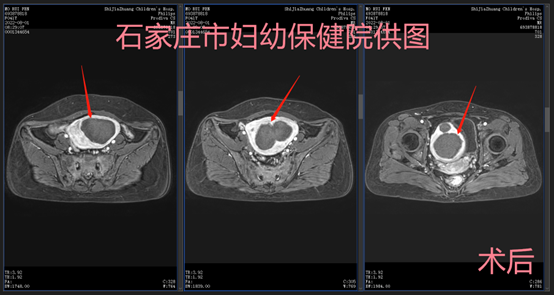 不开刀、不受罪，轻松解决子宫肌瘤