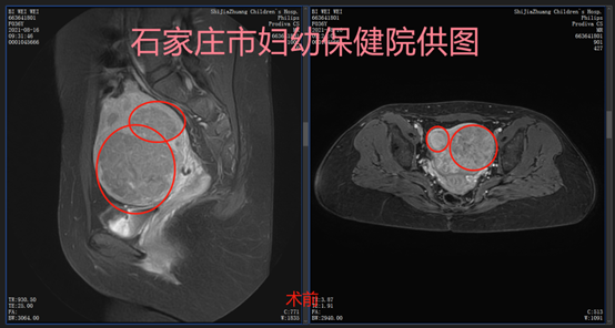 带着8厘米的肌瘤怀孕，她顺利生娃