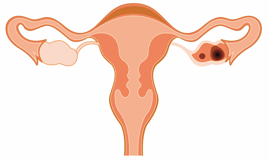 卵巢囊肿是什么原因引起的？
