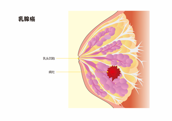 饮食、内衣、绝经……乳腺癌这些真相你了解吗