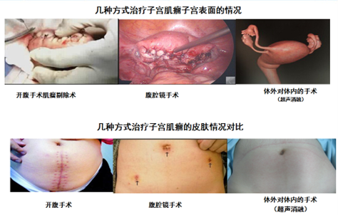 子宫肌瘤导致血色素41g/L，如何治疗才能避免再失血？