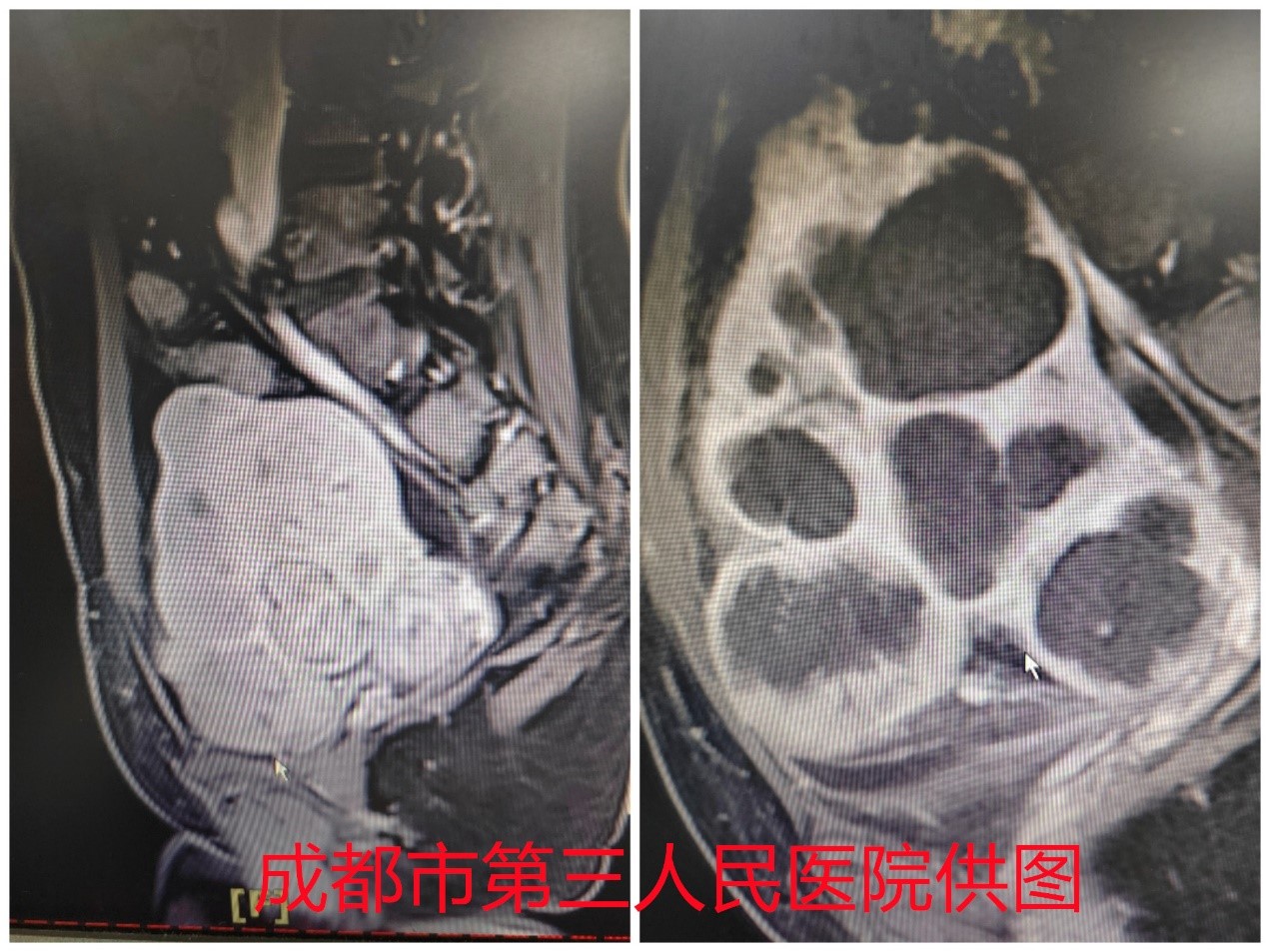 不开刀，却让50余个肌瘤一次性团灭，是如何做到的？