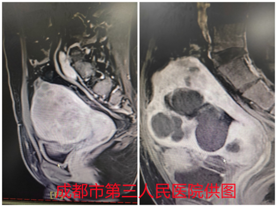 不开刀，却让50余个肌瘤一次性团灭，是如何做到的？