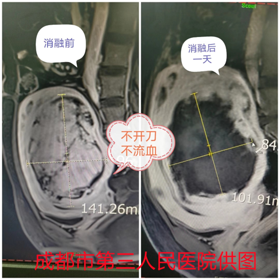 大龄未婚女性的14cm肌瘤治疗历程