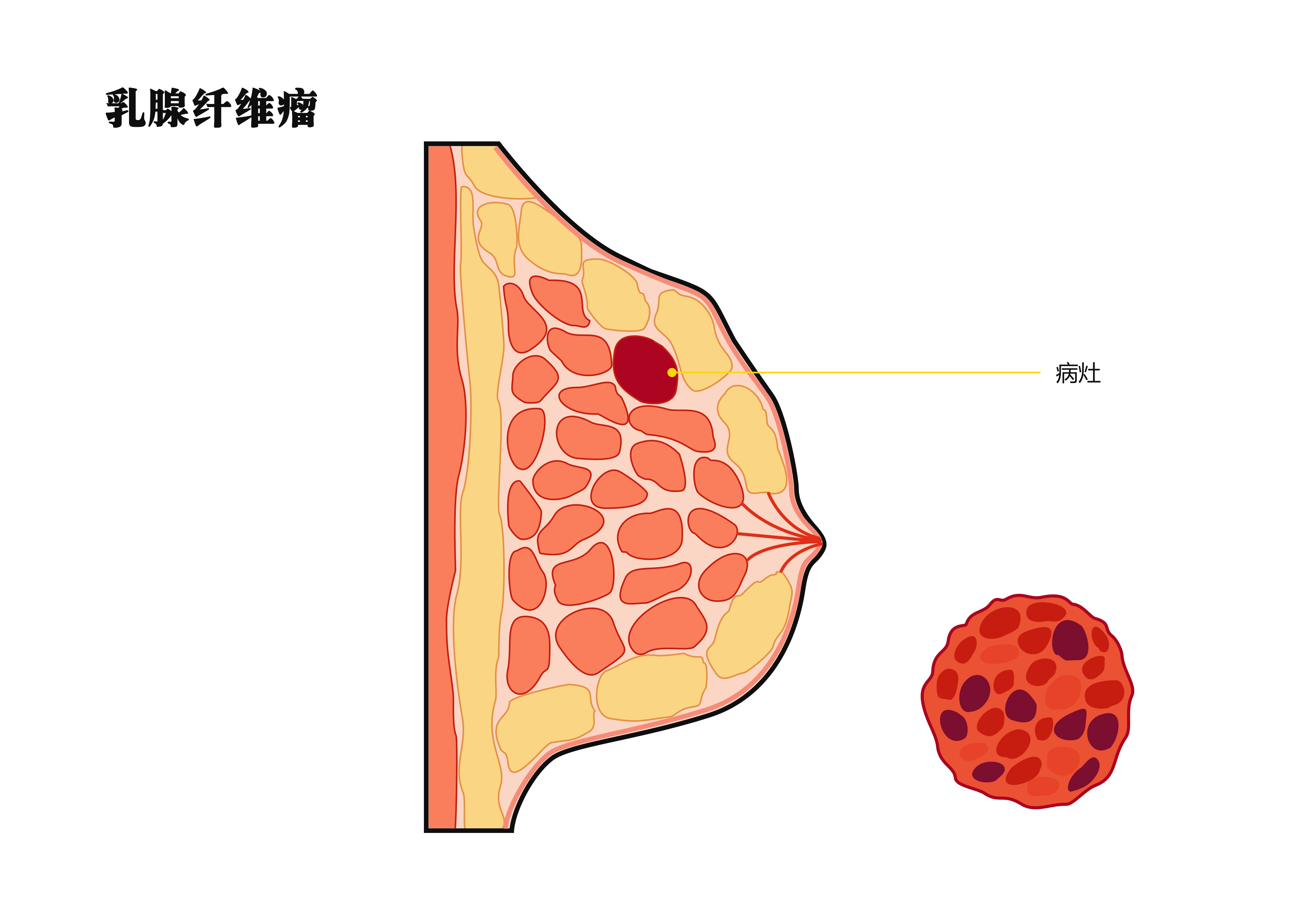 乳腺纤维瘤的三种常见手术方式？