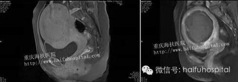 养瘤十五载，超声消融灭活大肌瘤